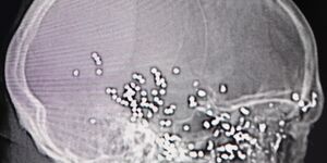 Side on X-ray image of Davidstar's head showing multiple bullet fragments