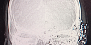 X-ray image of Davidstar's head showing multiple bullet fragments